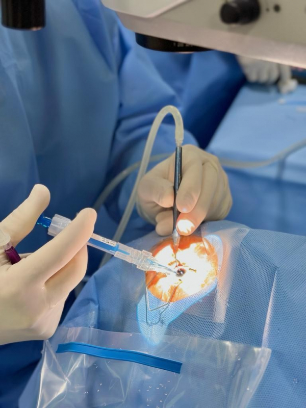 Cirurgia a Laser de Catarata Jarinu - Cirurgia de Catarata a Laser Consolação