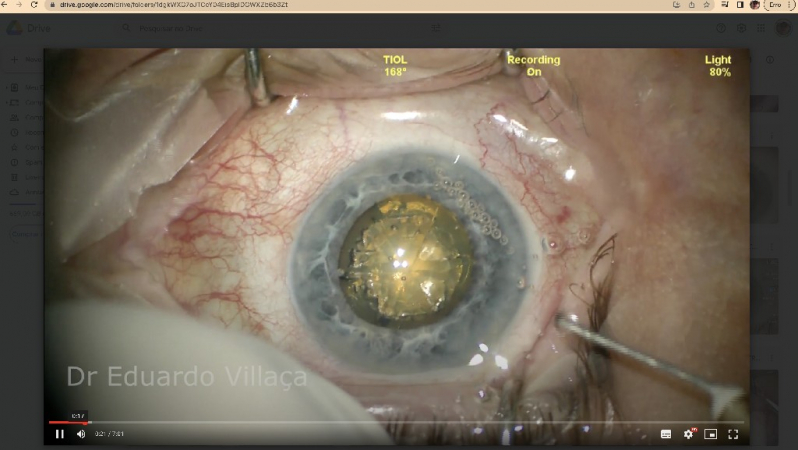 Cirurgia Catarata com Implante de Lente Marcar Jaguaré - Cirurgia de Catarata com Lente Multifocal