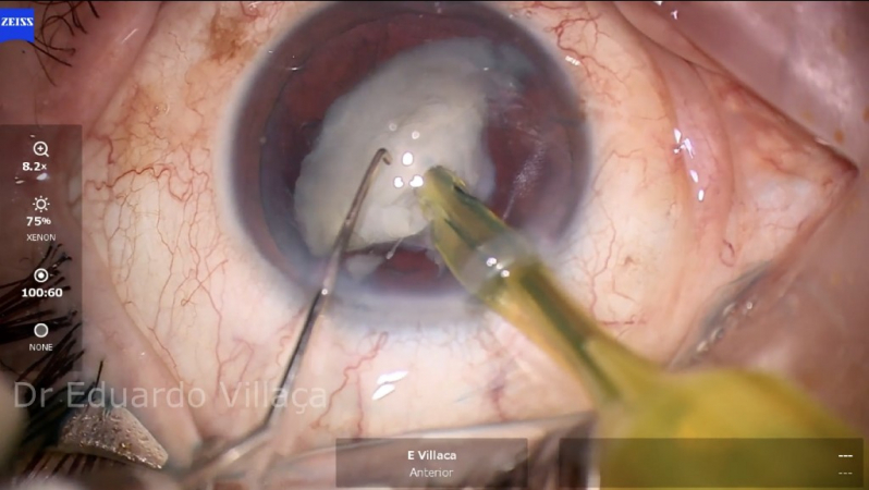 Cirurgia Catarata com Implante de Lente Cidade Centenário - Cirurgia de Catarata com Implante de Lente Multifocal
