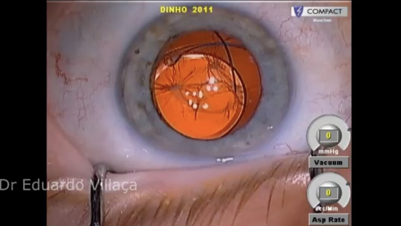 Cirurgia Catarata com Lente Alphaville Industrial - Cirurgia de Catarata com Implante de Lente Multifocal