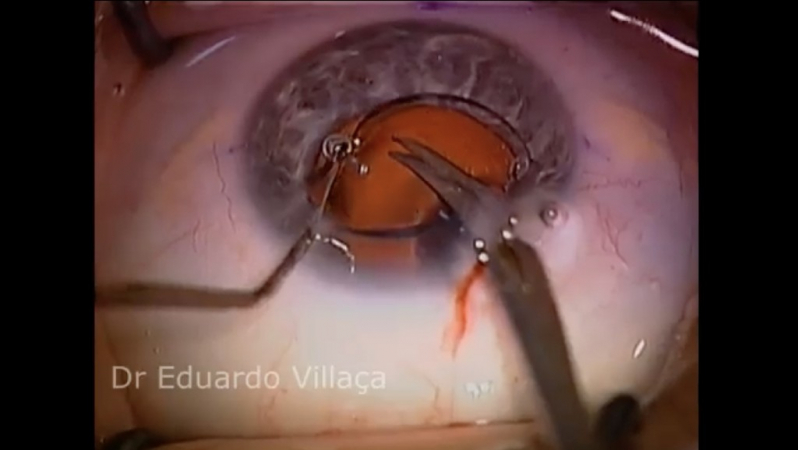 Cirurgia Catarata Facectomia Agendar Real Parque - Facectomia com Implante de Lente Intraocular