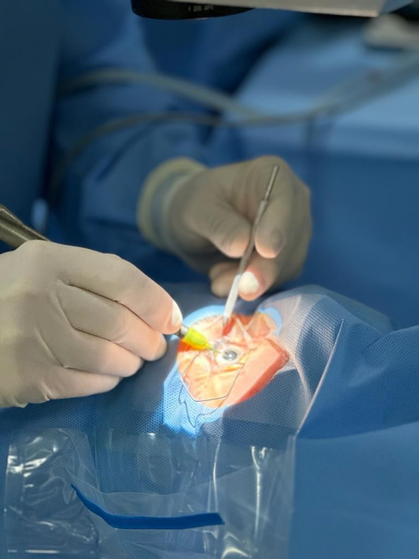 Cirurgia Catarata Facoemulsificação Marcar Alto da Boa Vista - Facoemulsificação com Implante de Lente