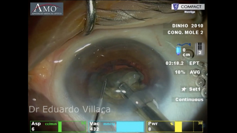 Cirurgia Catarata Lente Aricanduva - Cirurgia de Catarata com Implante de Lente Multifocal