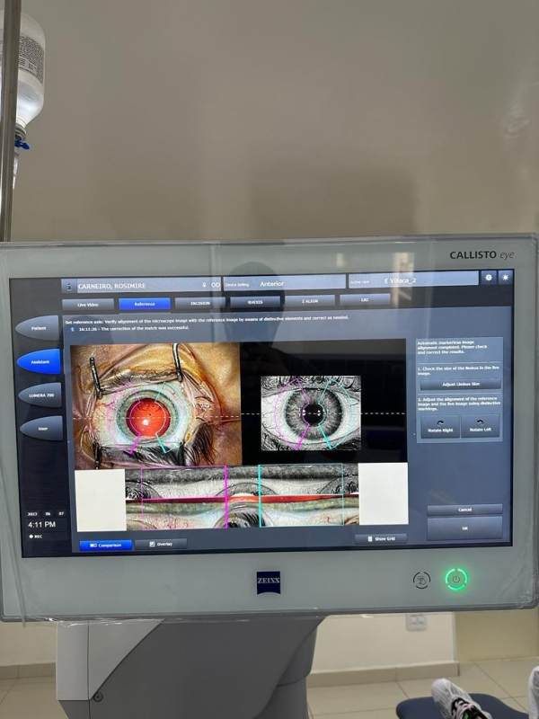 Cirurgia da Catarata com Laser Engenheiro Goulart - Cirurgia de Catarata com Laser