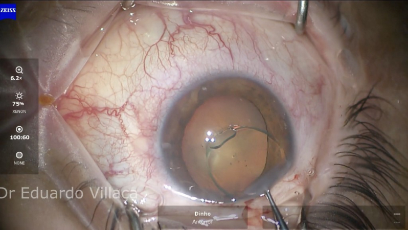 Cirurgia de Catarata com Colocação de Lente Marcar Lorena - Cirurgia de Catarata com Implante de Lente Multifocal