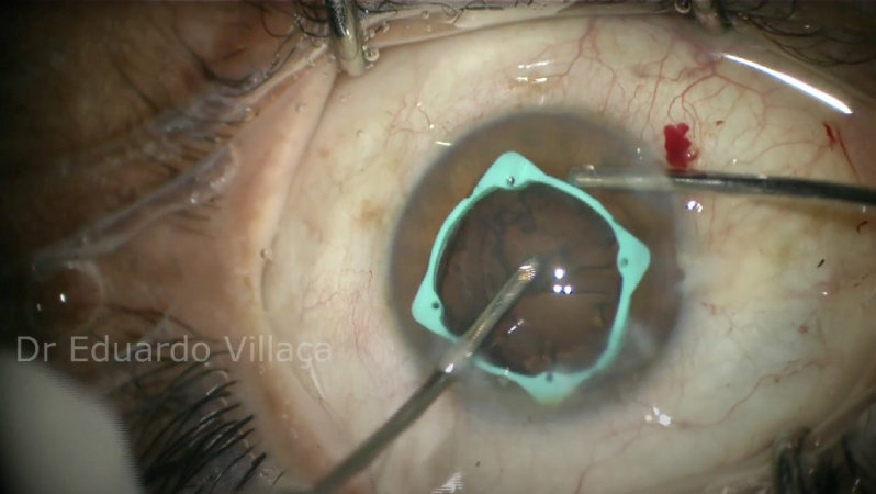 Cirurgia de Catarata com Colocação de Lente Vila Suzana - Cirurgia de Catarata com Implante de Lente Multifocal