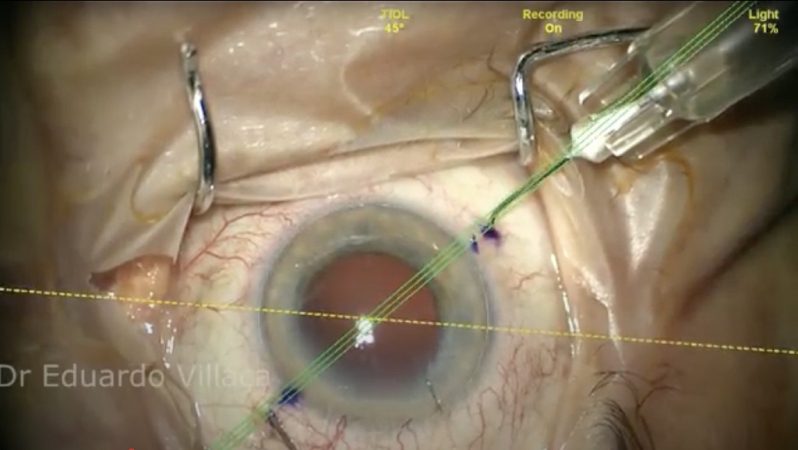 Cirurgia de Catarata com Implante de Lente Multifocal Cubatão - Cirurgia de Catarata com Implante de Lente Multifocal