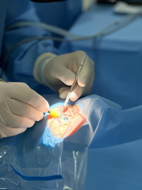 Cirurgia de Catarata com Implante de Lente Taboão da Serra - Cirurgia para Retirada de Catarata
