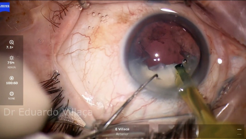 Cirurgia de Catarata com Lente Dentro do Olho Jardim São Saveiro - Cirurgia de Implante de Lente para Catarata