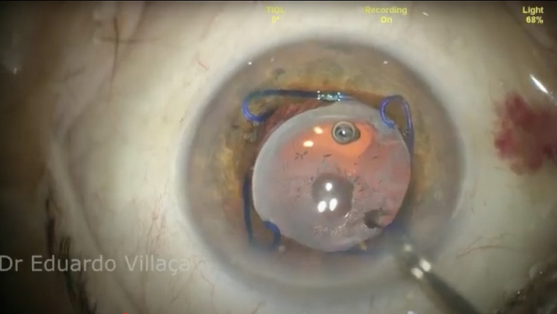 Cirurgia de Catarata com Lente Intra Ocular Marcar Granja Julieta - Cirurgia de Catarata com Lente Intra Ocular