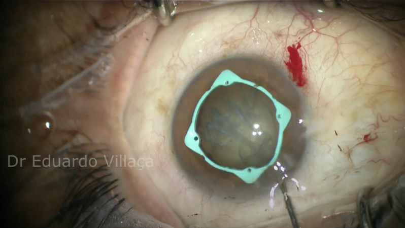 Cirurgia de Catarata com Lente Multifocal Parque São Rafael - Cirurgia de Catarata e Colocação de Lente