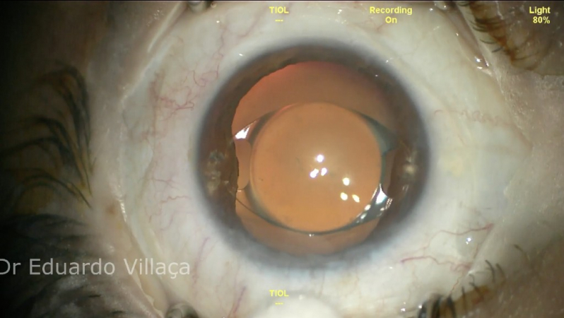 Cirurgia de Catarata com Lente Perus - Cirurgia de Catarata com Lente Multifocal
