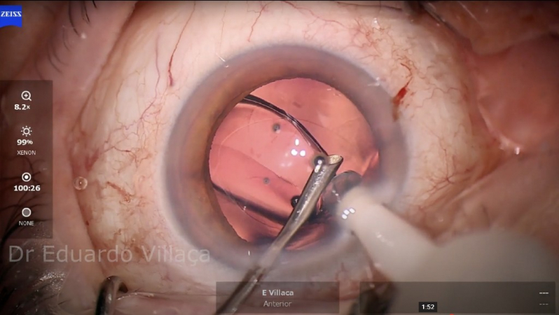 Cirurgia de Catarata e Colocação de Lente Marcar Mogi Guaçu - Cirurgia de Catarata com Implante de Lente Multifocal