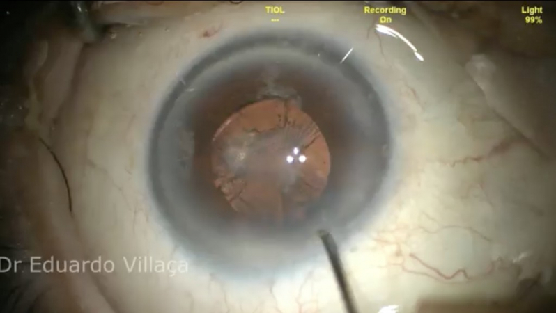 Cirurgia de Catarata em Idosos Diabéticos Marcar ARUJÁ - Cirurgia de Catarata com Lente Intra Ocular