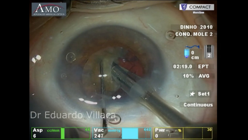 Cirurgia de Catarata Facectomia Agendar Vila Gomes Cardim - Facectomia com Implante de Lente Intra Ocular com Facoemulsificação