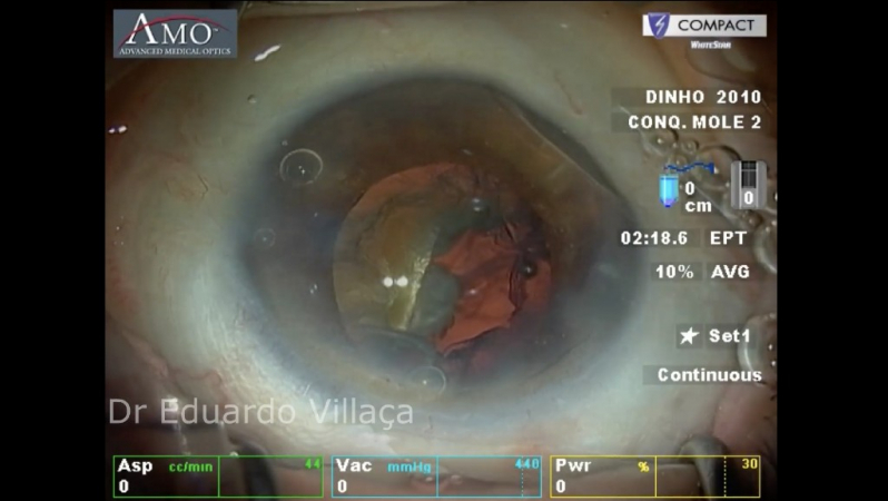 Cirurgia de Catarata Facectomia Vila Esperança - Facectomia com Implante de Lente Intra Ocular com Facoemulsificação
