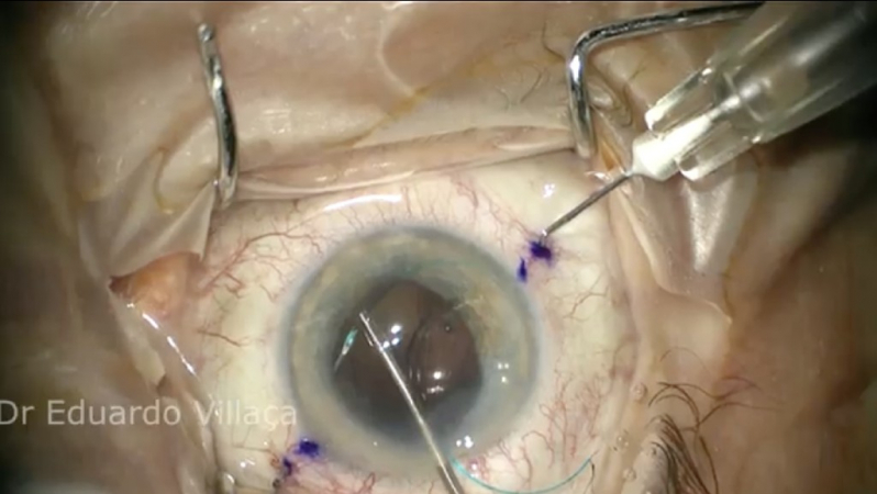 Cirurgia de Catarata Glaucoma Marcar Vila Cordeiro - Cirurgia de Catarata com Lente Intra Ocular