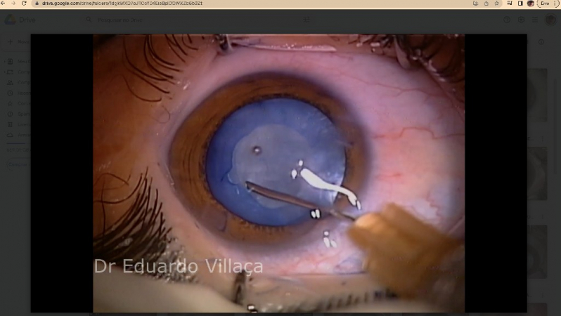 Cirurgia de Catarata Lente Intraocular Marcar Vila Romana - Cirurgia de Catarata com Implante de Lente Multifocal