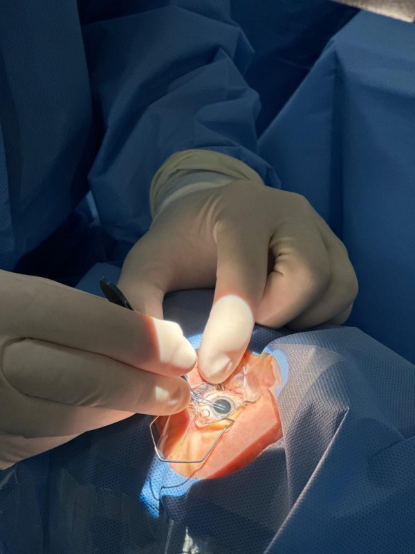 Cirurgia de Catarata por Facoemulsificação Piqueri - Facoemulsificação com Lio