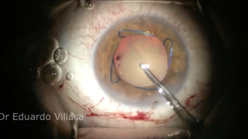 Cirurgia de Descolamento de Retina com Gás Itapecerica da Serra - Vitrectomia Posterior