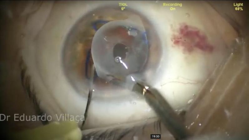 Cirurgia de Facectomia com Implante de Lio Agendar Vila Romero - Facectomia por Facoemulsificação
