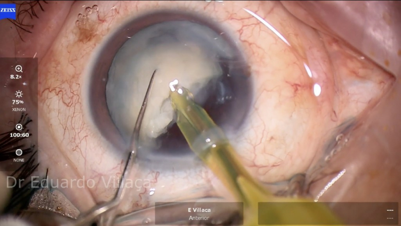 Cirurgia de Facectomia com Implante de Lio Imirim - Facectomia com Implante de Lente Intra Ocular com Facoemulsificação