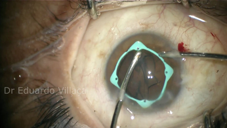 Cirurgia de Implante de Lente no Olho Jundiaí - Cirurgia de Implante de Lente para Catarata