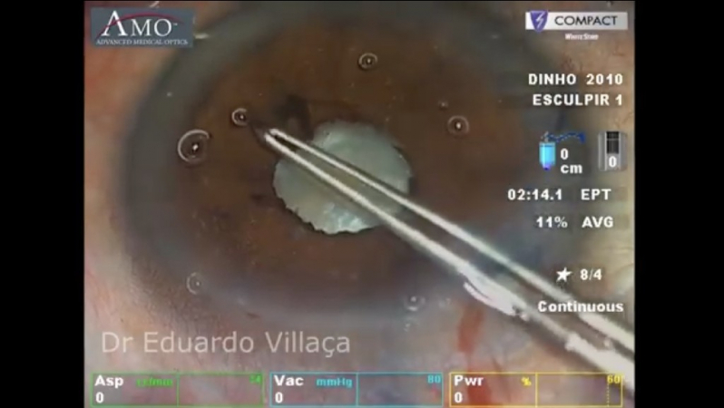 Cirurgia de Lente no Olho para Catarata Vila Santa Maria - Cirurgia de Implante de Lente para Catarata