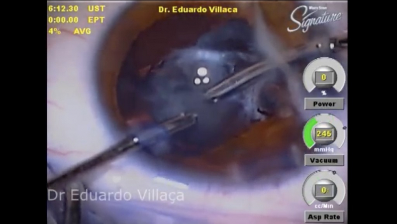 Cirurgia de Vitrectomia Agendar Zona Leste - Cirurgia de Descolamento de Retina com Gás