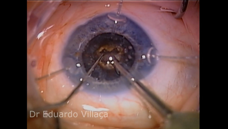 Cirurgia para Colocar Lente Intraocular Agendar Guararema - Cirurgia de Implante de Lente para Catarata