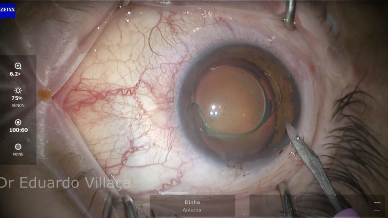 Cirurgia para Implantar Lente no Olho Cidade Ademar - Cirurgia de Implante de Lente para Catarata