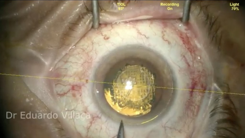 Cirurgia Vitrectomia Agendar Zona Oeste - Cirurgia de Descolamento de Retina com Gás