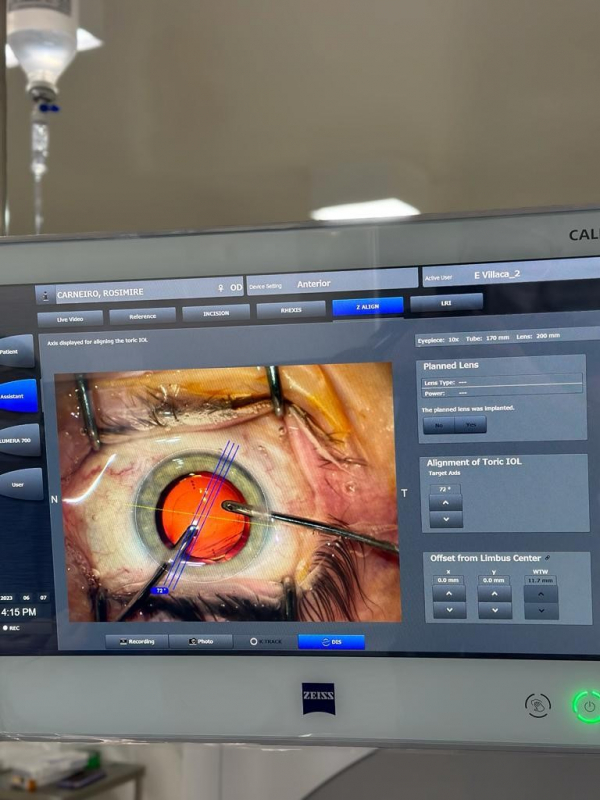 Clínica Especializada em Cirurgia Catarata a Laser Vila Roque - Cirurgia de Catarata a Laser com Implante de Lente