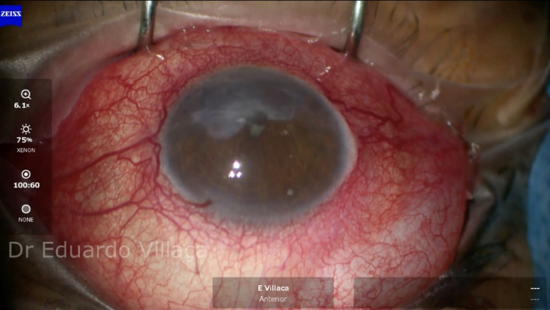 Clínica Que Faz Cirurgia de Lente no Olho para Catarata Poá - Cirurgia de Implante de Lente para Catarata