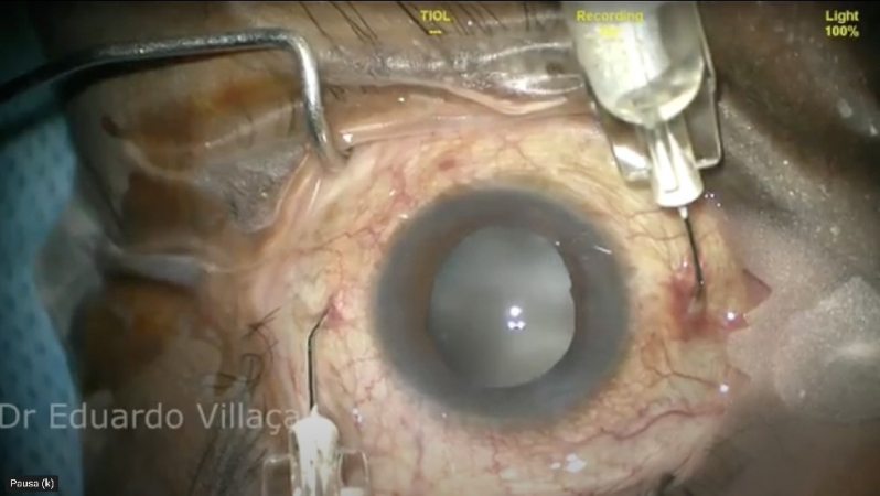 Clínica Que Faz Cirurgia de Vitrectomia Posterior Vila Gomes Cardim - Cirurgia de Descolamento de Retina com Gás