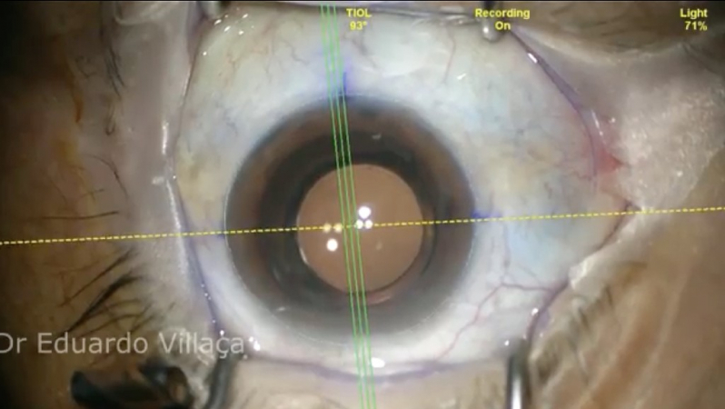 Clínica Que Faz Cirurgia para Colocar Lente nos Olhos Osvaldo Cruz - Cirurgia de Implante de Lente para Catarata
