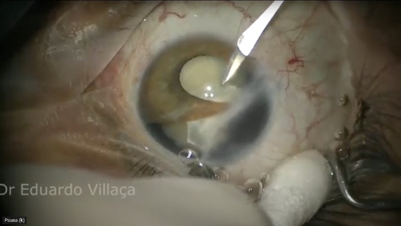 Clínica Que Faz Cirurgia Retina Vitrectomia Vila Gustavo - Cirurgia de Descolamento de Retina com Gás