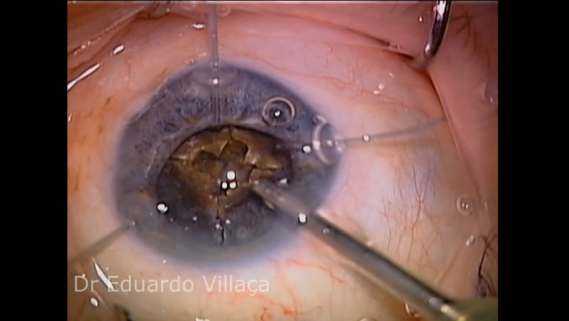 Clínica Que Faz Cirurgia Vitrectomia Zona Norte - Cirurgia de Descolamento de Retina com Gás