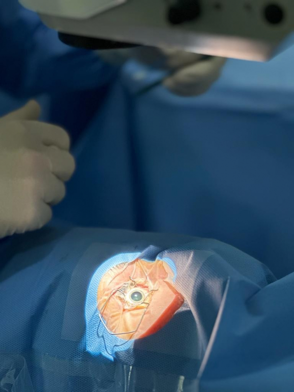 Clínica Que Faz Operação de Catarata com Implante de Lente Vila Formosa - Operação para Retirar Catarata