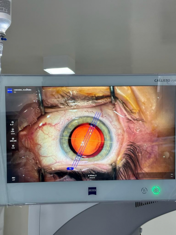 Clínica Que Faz Operação de Catarata no Olho Vila Santista - Operação de Catarata no Olho Consolação