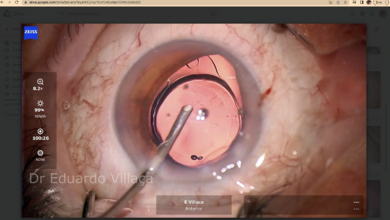 Clínica Que Faz Vitrectomia Posterior Rio Pequeno	S - Cirurgia de Descolamento de Retina com Gás