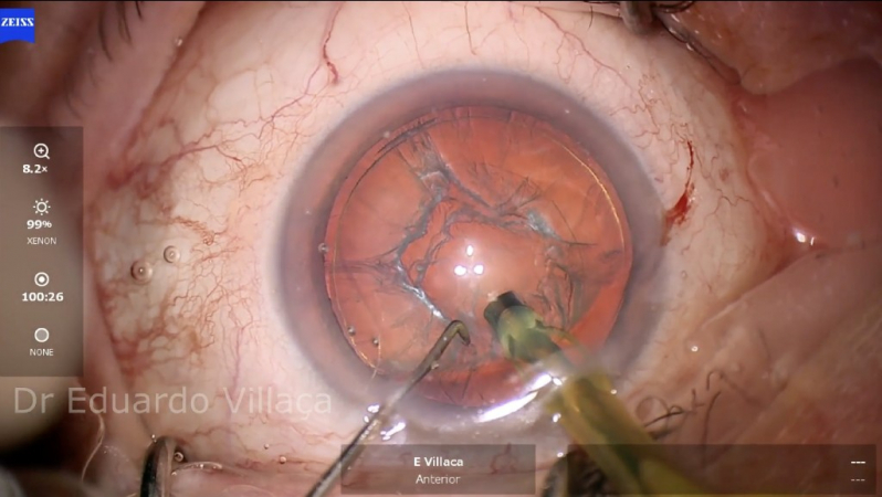 Facectomia com Implante de Lente Intraocular Agendar Jabaquara - Facectomia com Implante de Lente Intra Ocular com Facoemulsificação