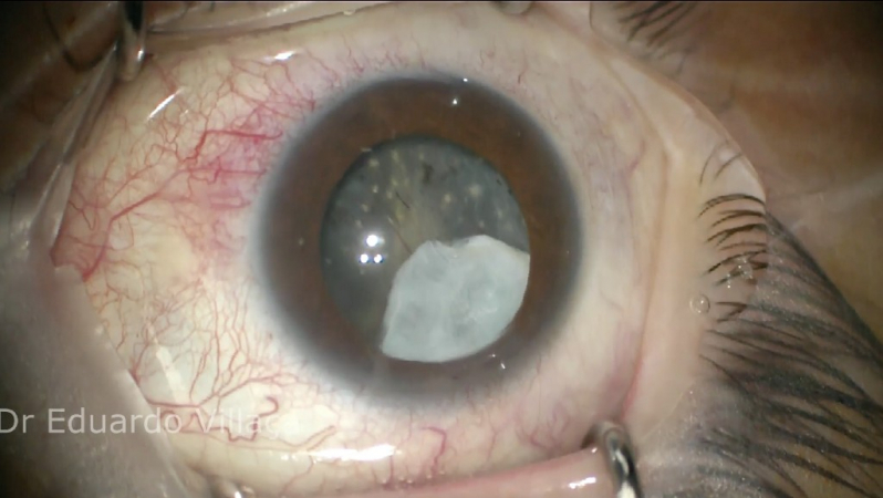 Facectomia com Implante de Lente Intraocular Imirim - Facectomia com Implante de Lente Intra Ocular com Facoemulsificação