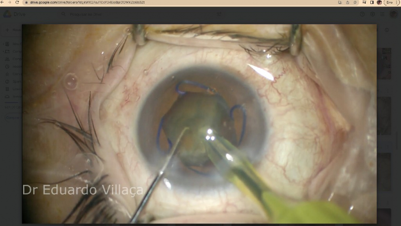 Onde Fazer Cirurgia Catarata Lente Jardim das Acácias - Cirurgia de Catarata com Implante de Lente Multifocal
