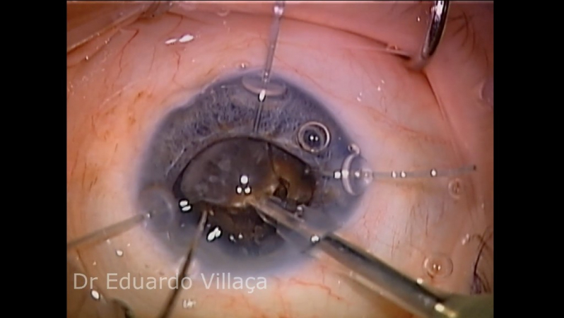 Onde Fazer Cirurgia de Catarata com Implante Parque São Rafael - Cirurgia de Catarata para Diabeticos