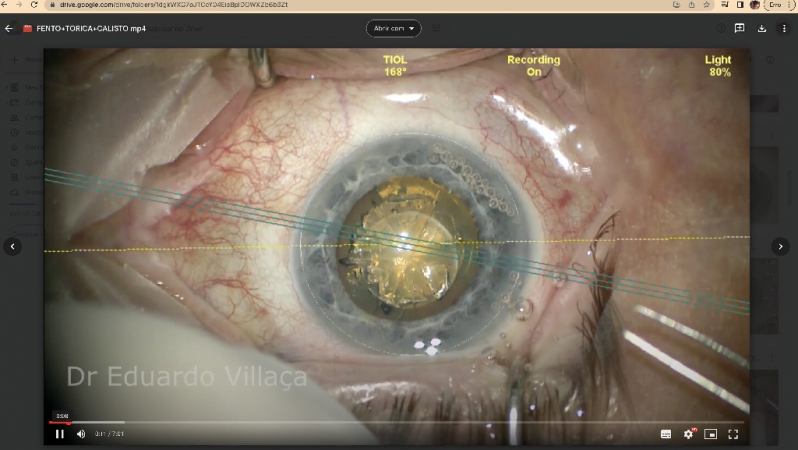 Onde Fazer Cirurgia de Catarata com Lente Importada Alto de Pinheiros - Cirurgia de Catarata com Implante de Lente Multifocal