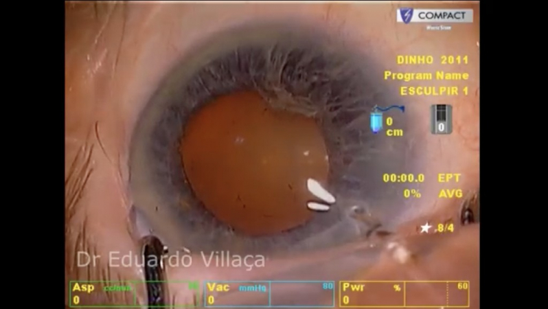 Onde Fazer Cirurgia de Catarata Glaucoma Água Funda - Cirurgia de Catarata com Lente Intra Ocular