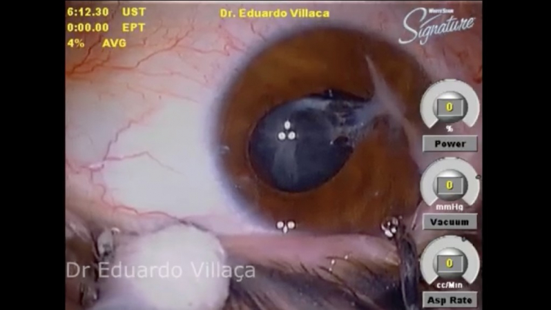 Onde Marcar Facectomia com Implante de Lente Intra Ocular com Facoemulsificação Parque São Jorge - Cirurgia de Catarata Facectomia