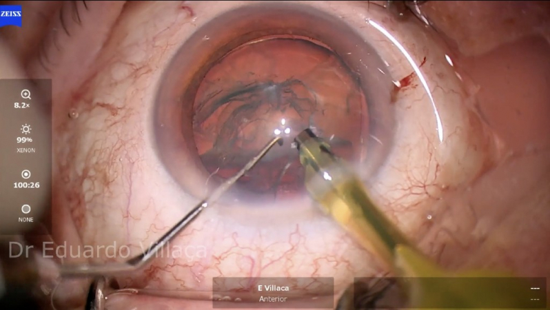 Onde Marcar Facectomia com Implante de Lente Intraocular São Caetano do Sul - Facectomia com Implante de Lente Intra Ocular com Facoemulsificação
