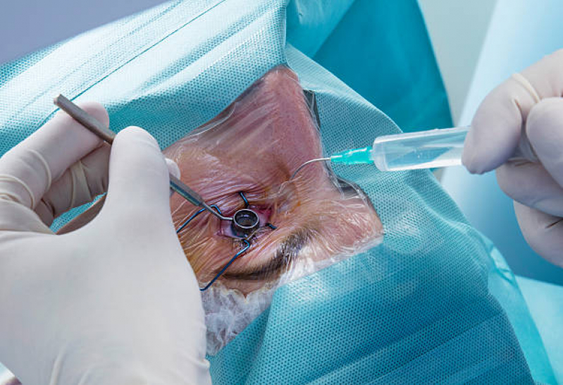 Operação de Catarata com Lente Marcar Vila Esperança - Operação de Catarata no Olho Consolação